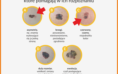 Zdjęcie do #Czerniak18+